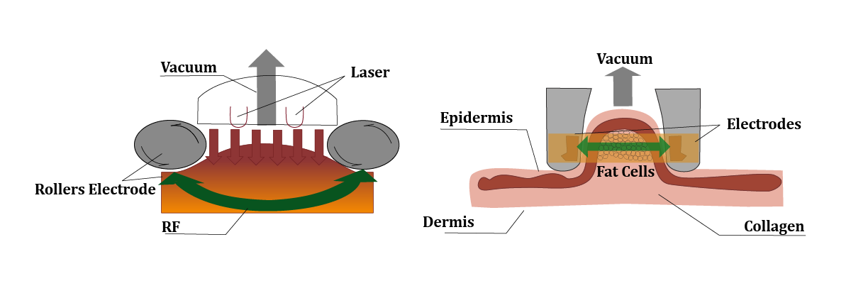 What Results to Expect from Vacuum RF Roller? 2 03-Vacuum-rf-roller-machine
