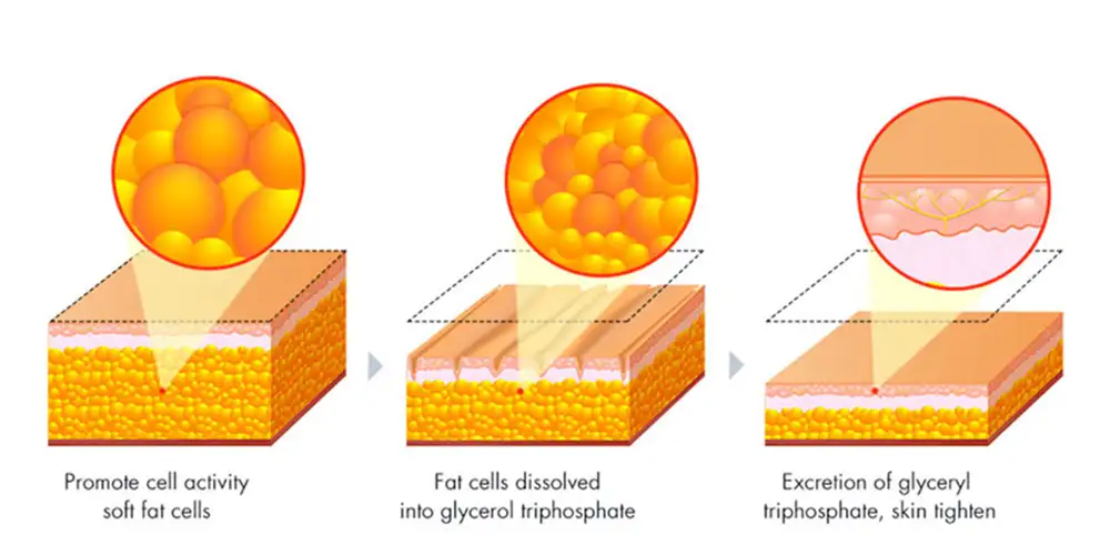 lipo laser